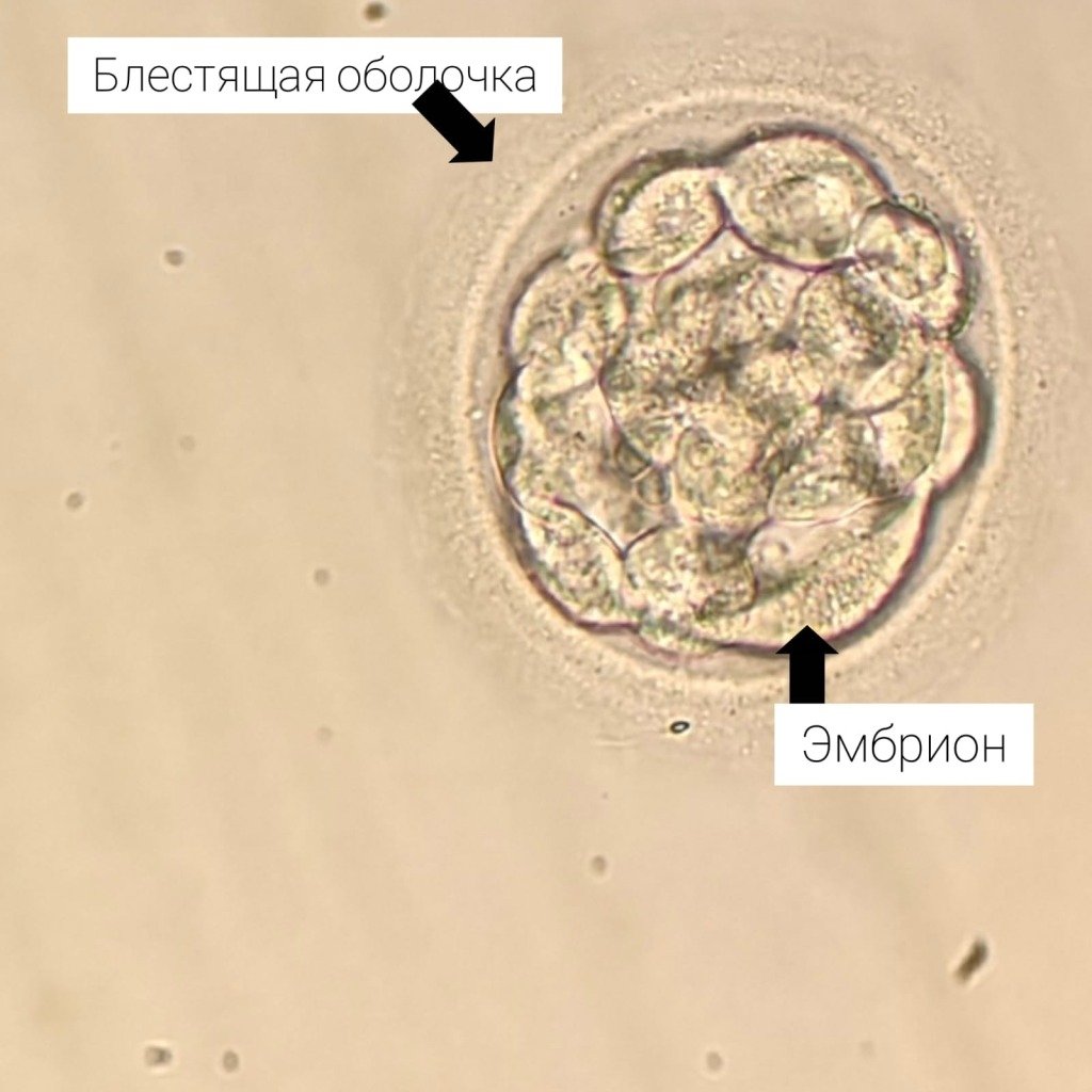 На фото эмбрион 5-х суток, ему сделала процедура вспомогательного хэтчинга